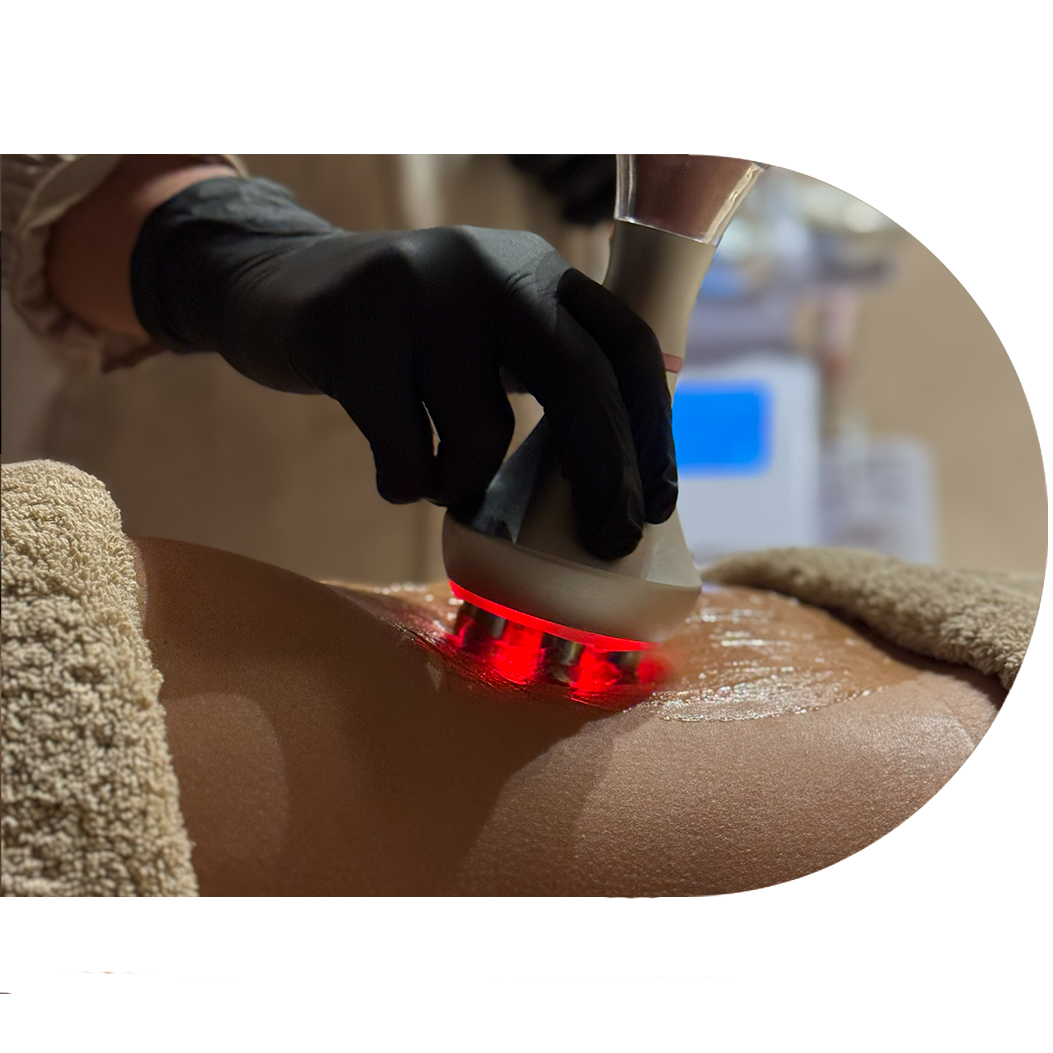 Tratamento tecnológico indicado para o recondicionamento da pele com celulite, que associa vácuo e radiofrequência multipolar.