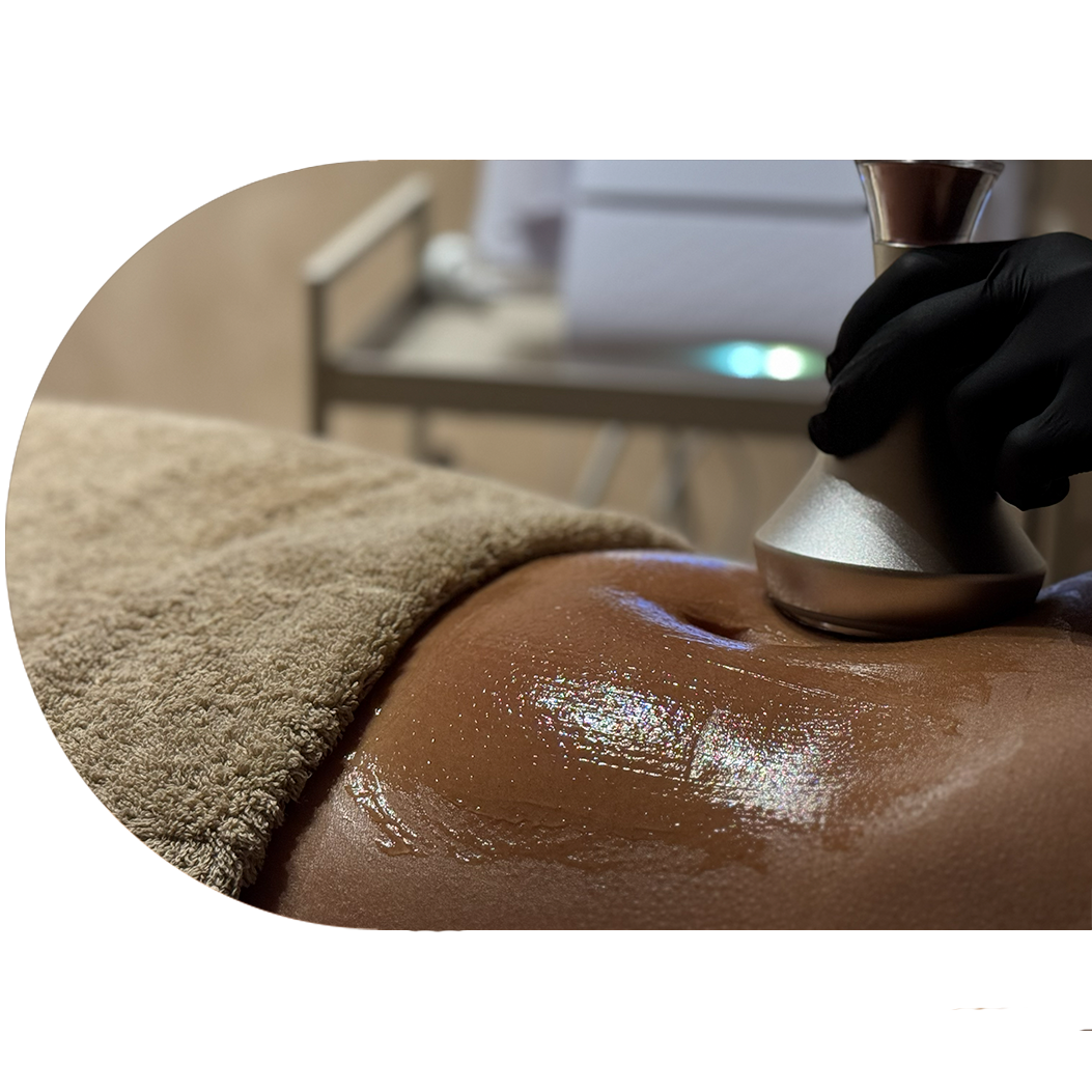 Protocolo corporal tecnológico voltado para a redução de gordura localizada, que associa Lipo Laser e Cavitação 80k.